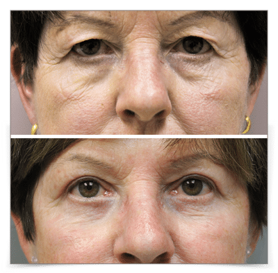 Upper & Lower Blepharoplasty