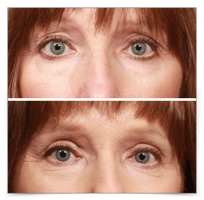 Upper Blepharoplasty & Browlift