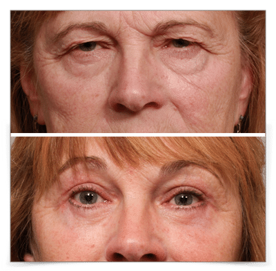 Upper & Lower Blepharoplasty