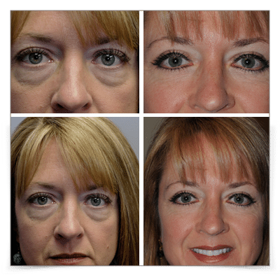 Upper & Lower Blepharoplasty