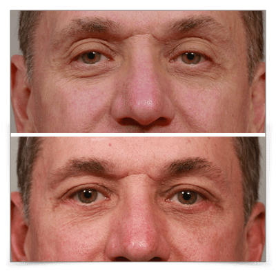 Upper & Lower Blepharoplasty