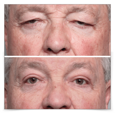Upper Blepharoplasty