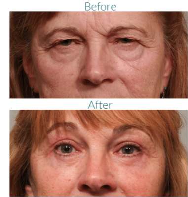 Before/After Blepharoplasty Photos