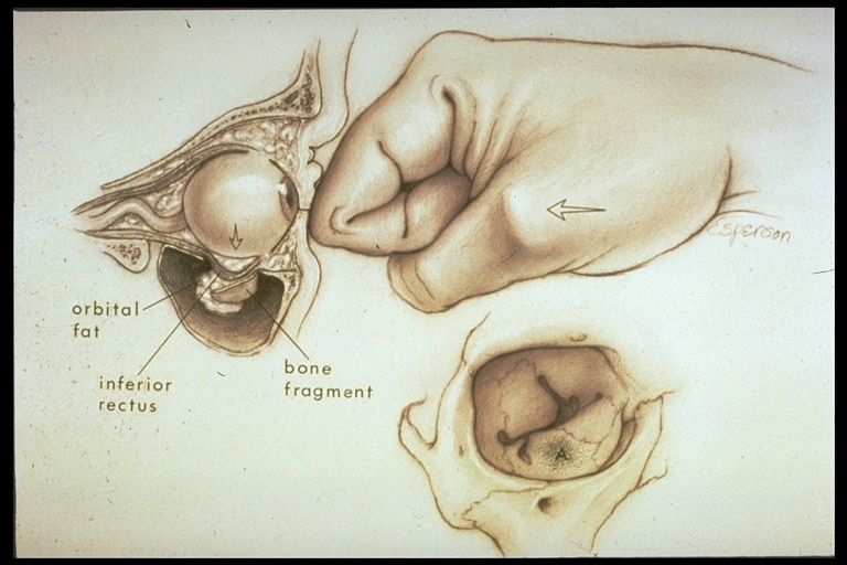 Orbital Fracture Treatment Denver Orbital Fracture Repair Boulder Co