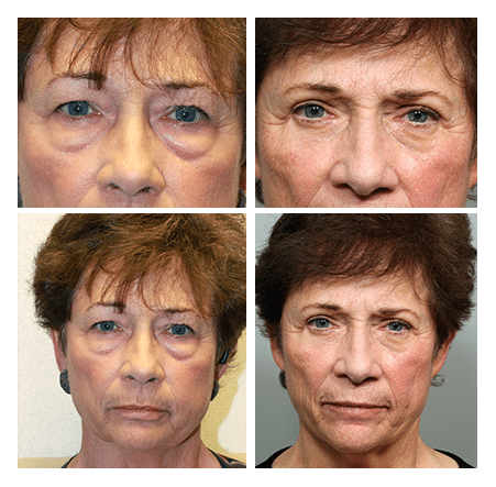 upper and lower blepharoplasty
