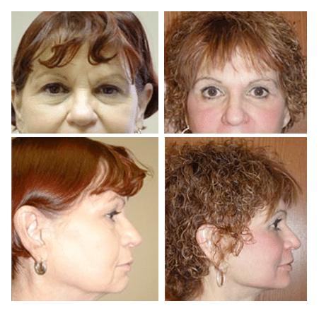 Eyelid & Face and Neck Lift