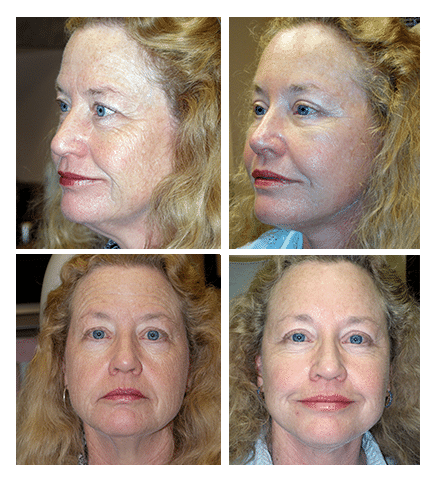 upper and lower blepharoplasty, endoscopic browlift, face and necklift
