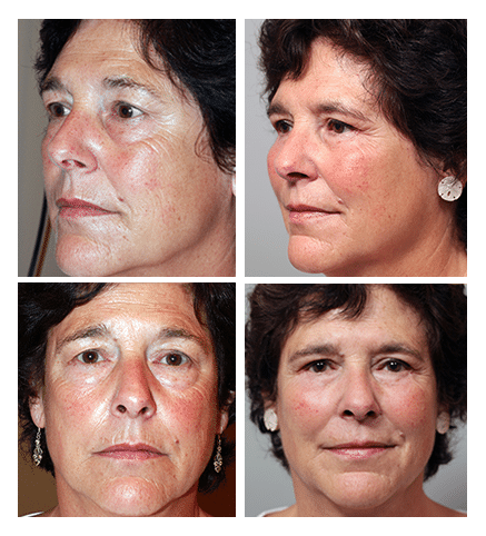 upper and lower blepharoplasty, endoscopic midface lift