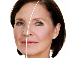 Laser Skin Resurfacing Denver | Boulder CO