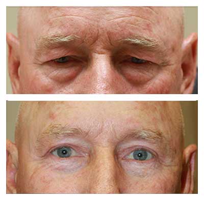 Upper and Lower Blepharoplasty