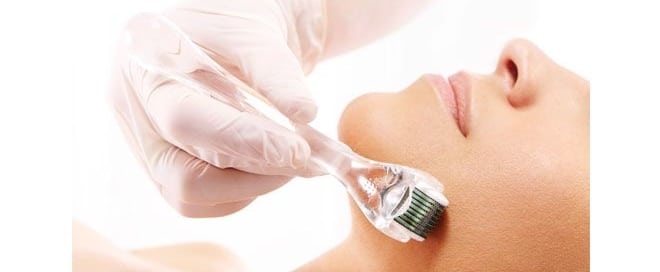 microneedling 660x272 1