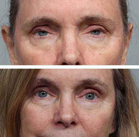 Eyelid Ptosis Denver CO Eyelid Ptosis Denver CO