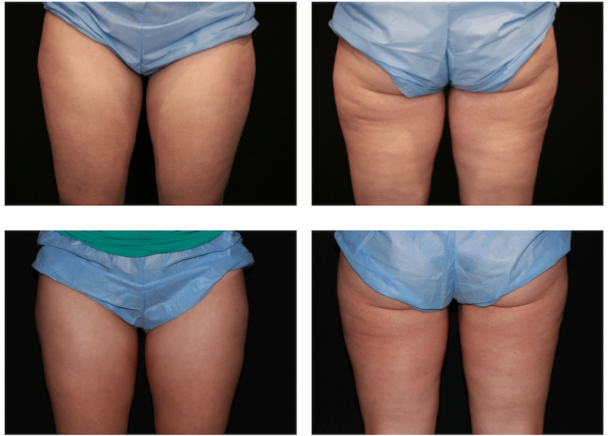 CoolSculpting Thighs Before & After CoolSculpting Thighs Before & After