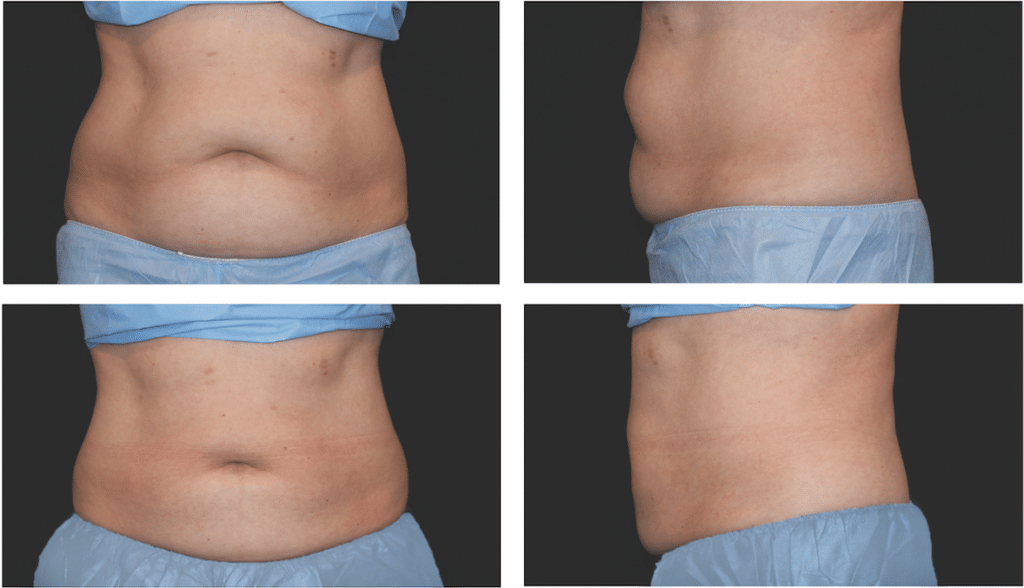 CoolSculpting Before & After CoolSculpting Before & After