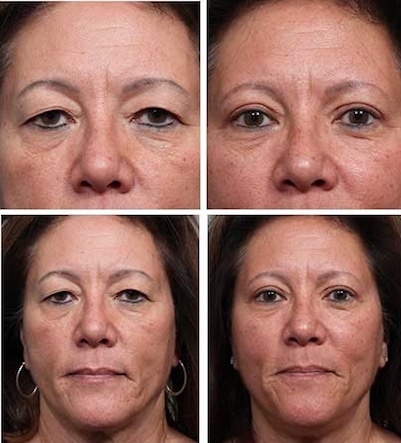 Upper Blepharoplasty Denver CO Upper Blepharoplasty Denver CO