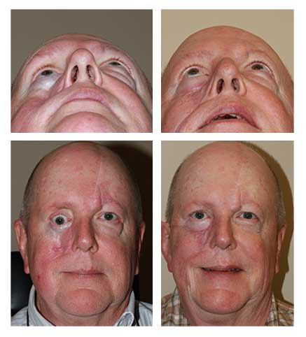Reconstructive Eye Surgery Denver CO Reconstructive Eye Surgery Denver CO