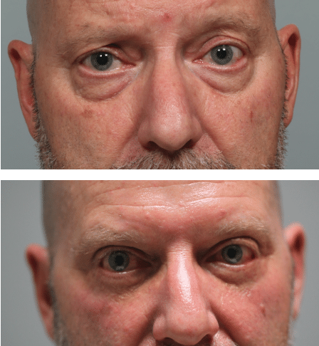 Upper and Lower blepharoplasty, Ptosis repair on the right eye