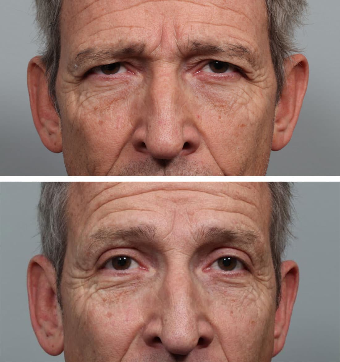 Reconstructive Eye Surgery Denver CO Bilateral Upper Blepharoplasty Denver, CO