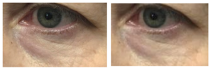 Before & After Accutite Treatment