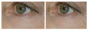 Before & After Accutite Treatment