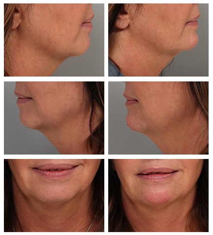 25 Before After Voluma chin