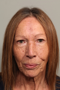 Basal Cell Carcinoma After Removal