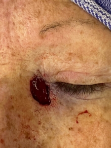 Basal Cell Carcinoma During Removal