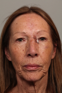 Basal Cell Carcinoma After Removal