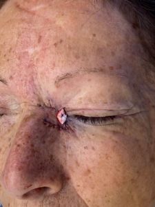 Basal Cell Carcinoma Immediately After Removal