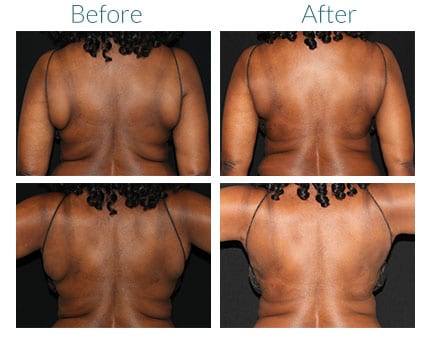 before and after Body Sculpting Denver CO