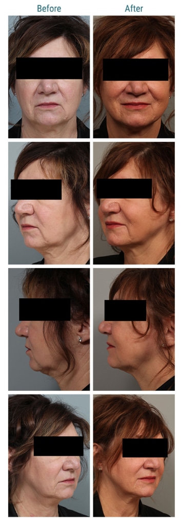 before and after neck Sculpting Denver CO