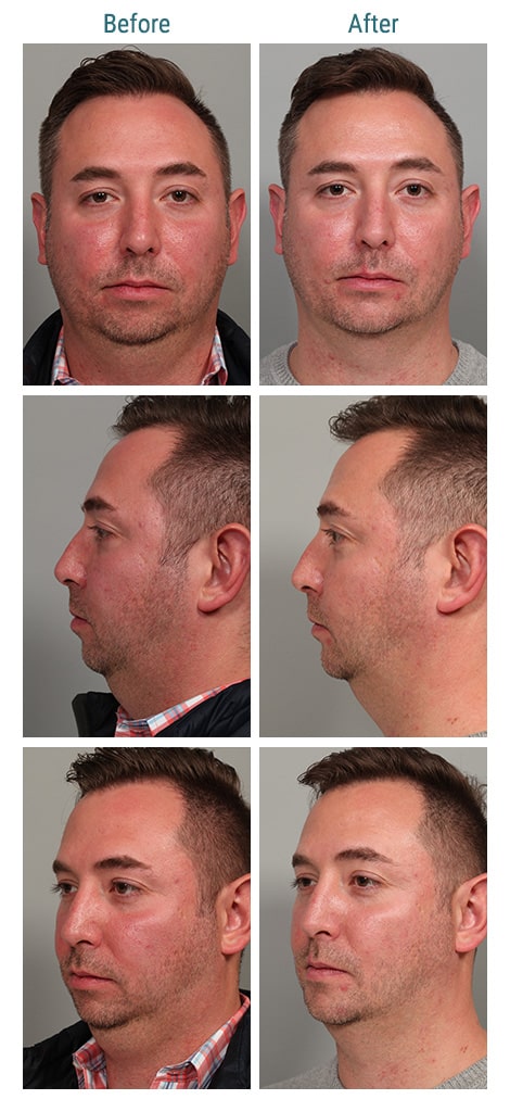 before and after neck & chin Sculpting Denver CO