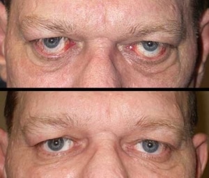 before and after photos of old man's eyes showing bulging eyes being fixed