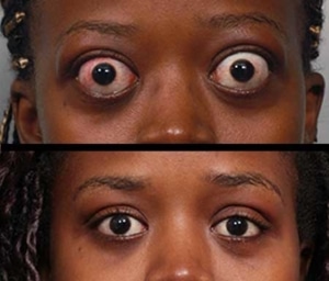 before and after photo of woman's eyes showing bulging eyes being fixed