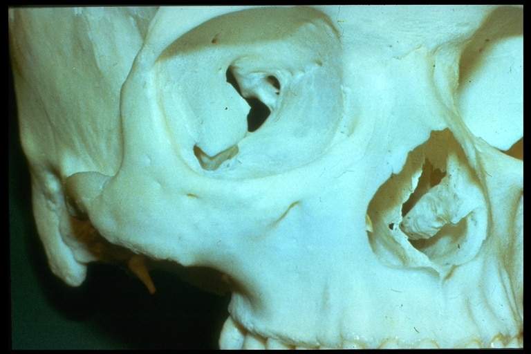 View of orbital bones showing the delicate floor and inner wall