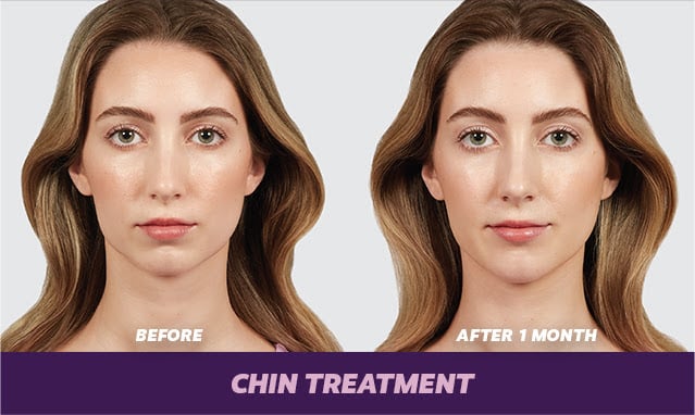 before and after Juvéderm voluma Denver CO
