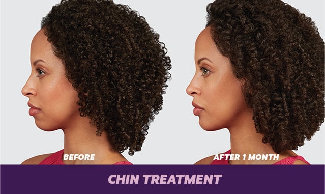 before and after Juvéderm voluma Aurora CO