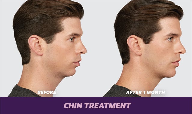 before and after chin voluma Denver CO
