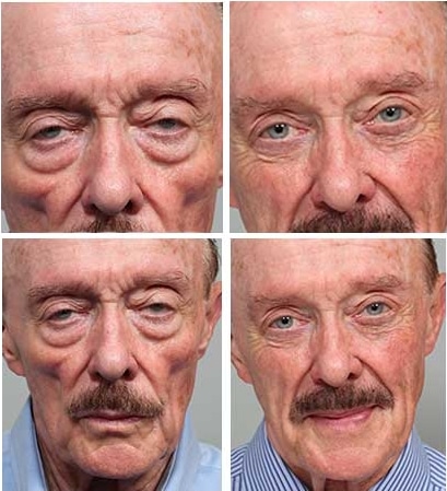 before and after Sculptra Injection Treatment Aurora CO
