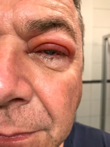 Orbital Cellulitis Surgery Aurora CO