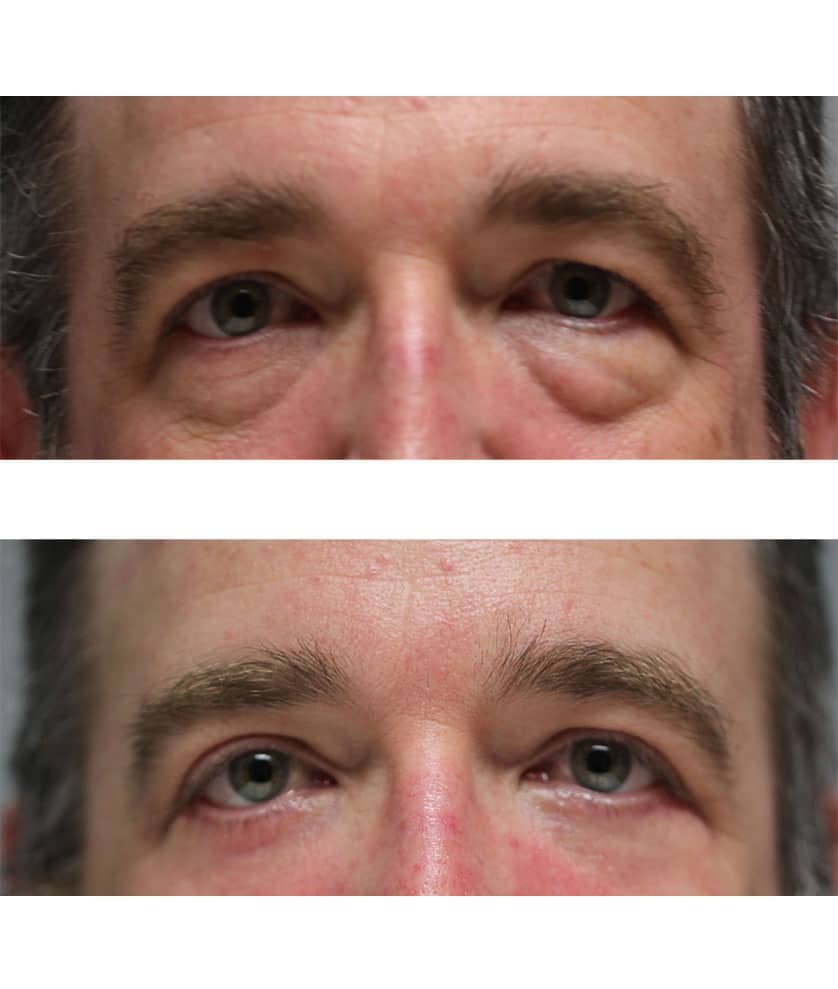 before and after photos of old man's eyes after eyelid surgery