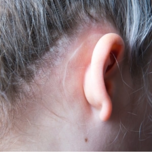 otoplasty surgery Denver CO