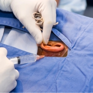 Otoplasty treatment Aurora CO