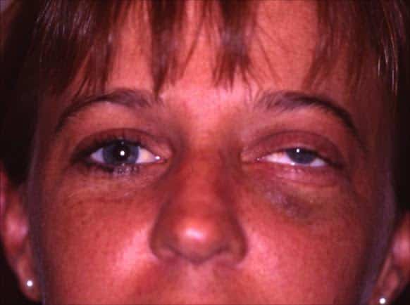 Orbital Fracture Surgery Denver CO