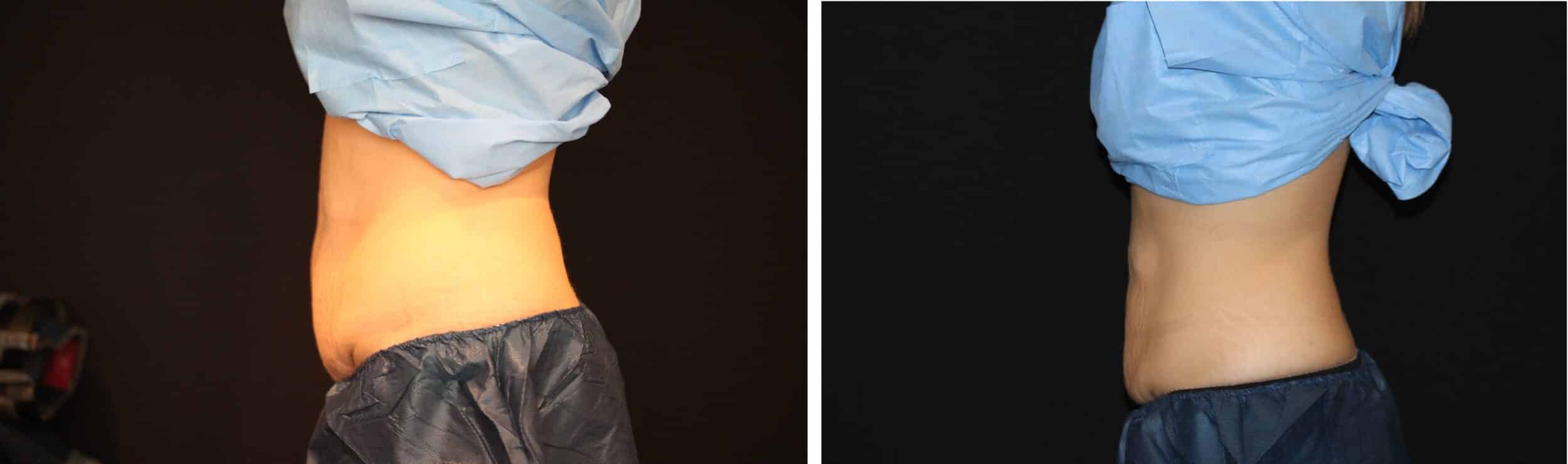 side view of woman’s bare stomach before and after coolsculpting, flatter after procedure