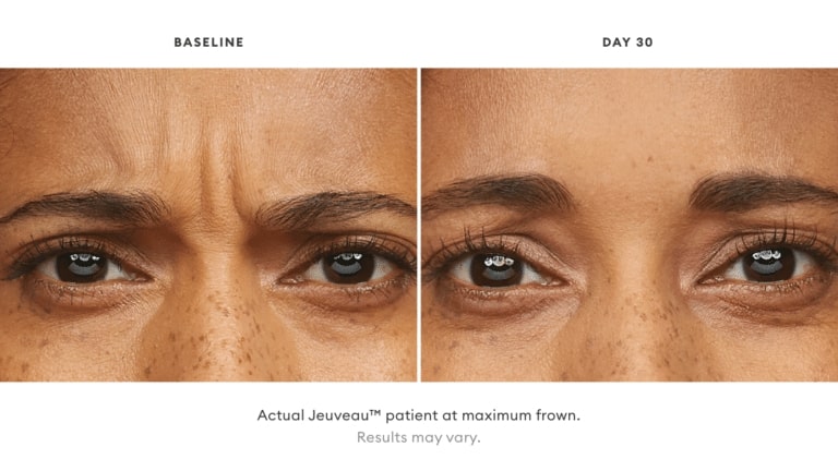 before and after botox treatment Aurora CO