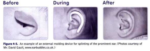 Dr. Fante Infant Ear Molding e1509715341924