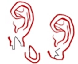 Gauged Ear Lobe Repair