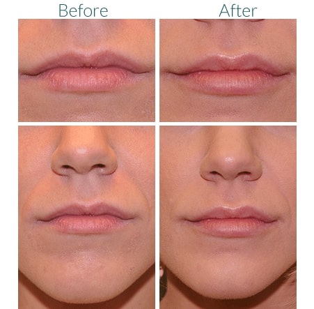before and after lip filler Denver CO