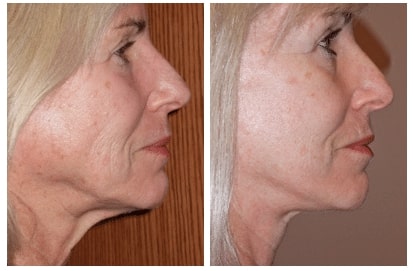 Neck Lift Before After Photo